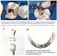 Dental Tofflemire Matrix for Deep Margin Elevation Large Curvature Matrices Retainer Sectional Contoured Matrice