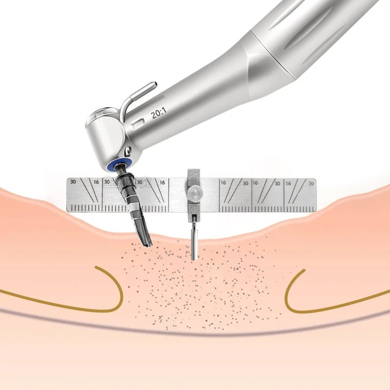 Implant Angle Locator Ruler