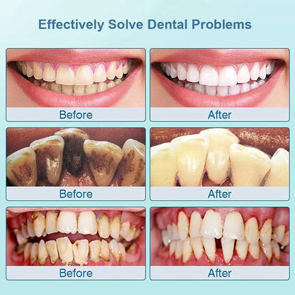 Before and After pictures of teeth